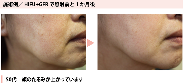 施術例50代 たるみ