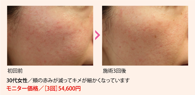 施術例30代 きめ細かくなった