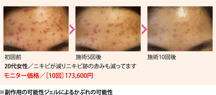 施術例20代 ニキビが減った