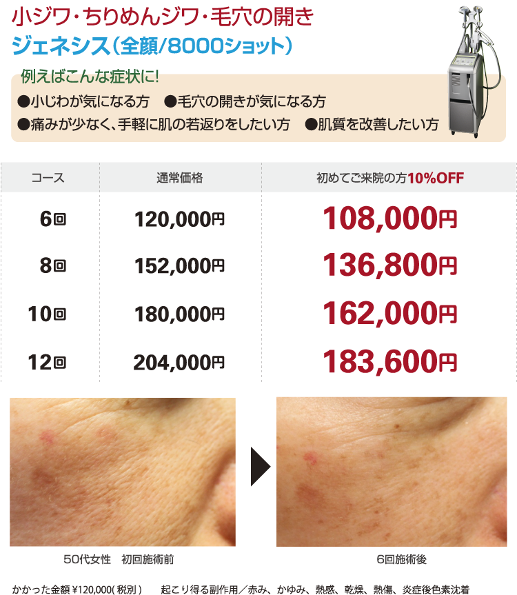 小じわ・ちりめんジワ・毛穴の開き ジェネシス