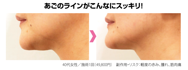アゴのラインがこんなにスッキリ!