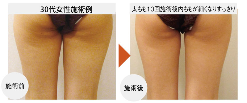 エクシリスエリートBefore・After